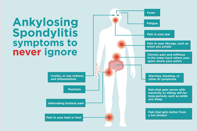 ANKYLOSING_spondylitis.jpg